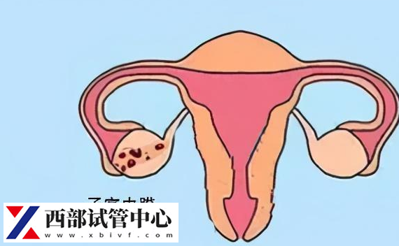 子宮內(nèi)膜異位癥是婦科疾病